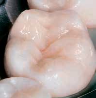 Ecusphere Carat - после реставрации